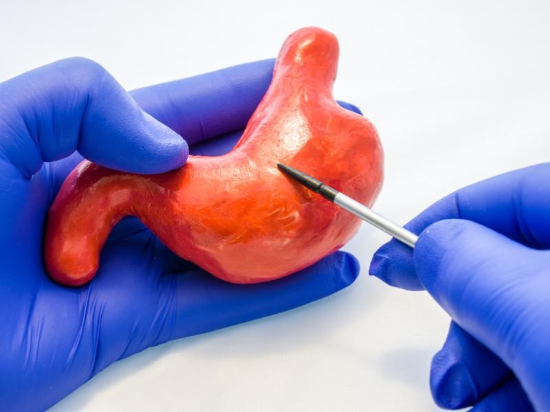 Tipos de Cirurgia Bariátrica: Qual é a Mais Adequada para o Paciente?